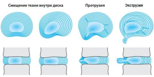 Деформации затрагивают ткани внутри диска, что постепенно приводит к разрыву фиброзного кольца