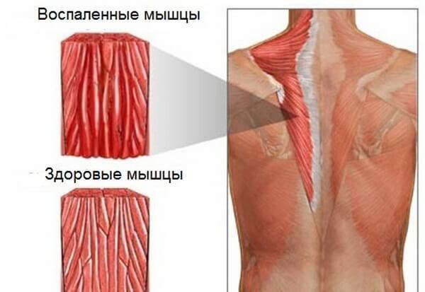 Характерным признаком мышечной дорсопатии является воспаление мышц (миозит) на проблемном участке спины