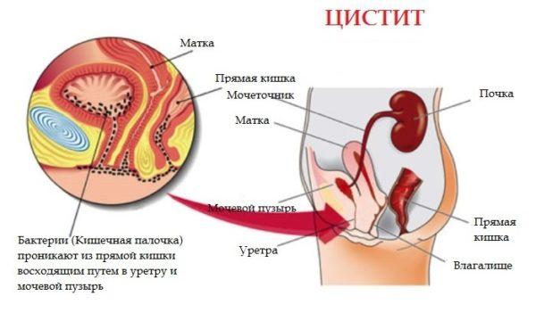 В большинстве случаев цистит поражает женщин, причина – анатомические особенности строения мочевой системы