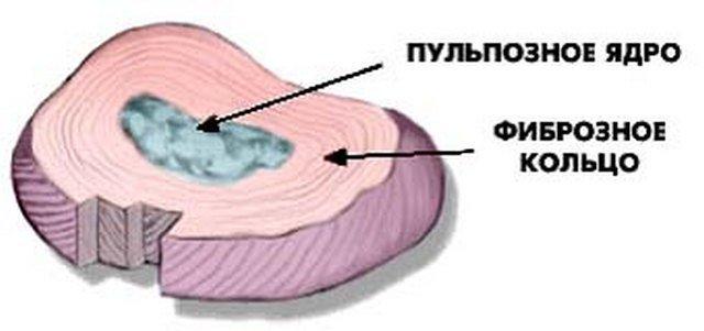 Схема-изображение межпозвонкового диска – места, откуда начинается развитие грыжи