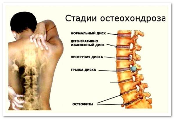 Российскими ортопедами выделяется 4 стадии остеохондроза